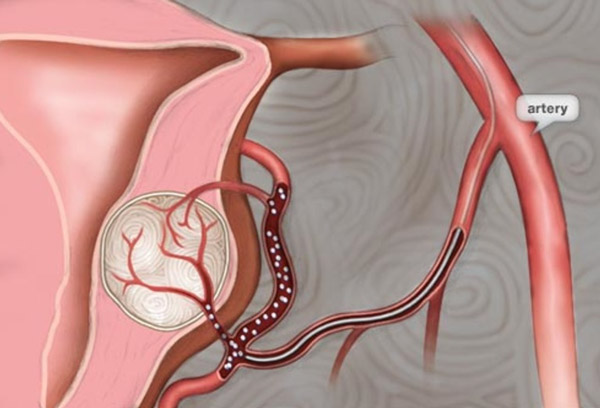 Thuyên tắc mạch tử cung điều trị u xơ có thể có hai cho thai nghén sau này 